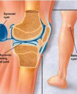 a boka posztraumás deformáló artrózisának kezelése