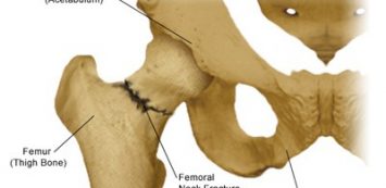 miért fáj a protézis csípőízület