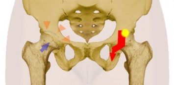 A csípőízület artrózisa 1 fokos kezelési fórum - Szakaszai ízületi ízületi