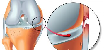 a térd ligamentitis kezelése kenőcs a lábujjak ízületeinek fájdalmára
