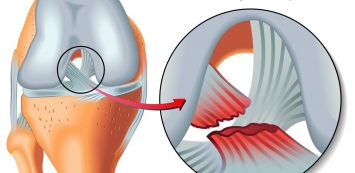térdízület külső ligamentum sérülése)