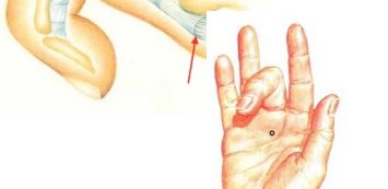 a kéz könyökízületének gyulladása thebantin ízületi fájdalmak kezelésére