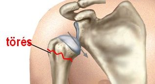 A váll anatómiája: a váll leggyakoribb sérülései és kezelési módjai | a javulás útjai